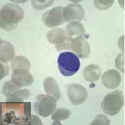 Lymfoma